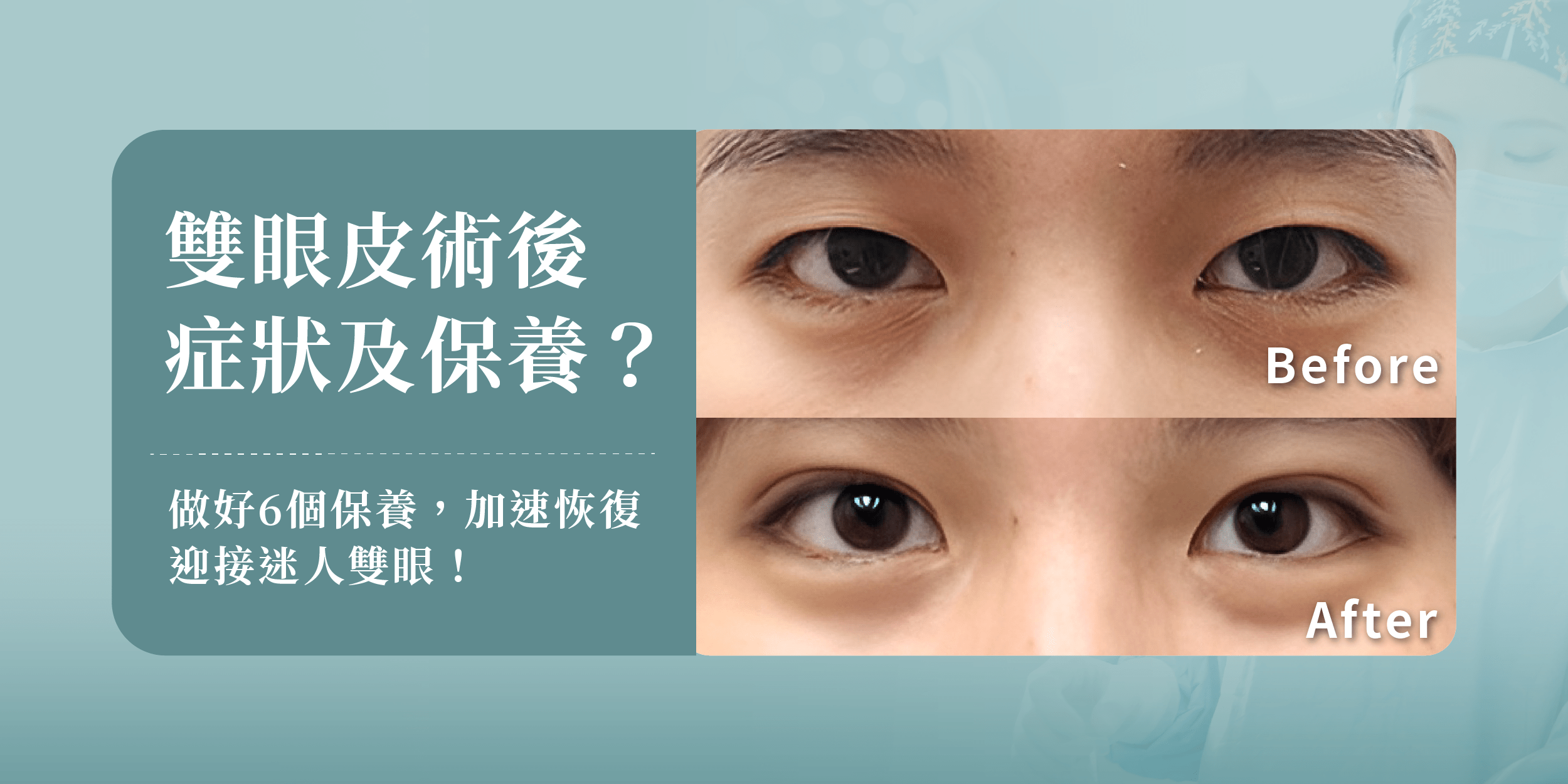 雙眼皮手術術後常見的併發症症狀與6個術後保養方法