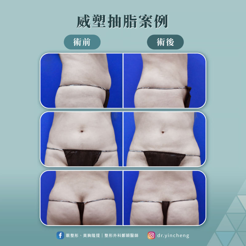 威塑抽脂個案手術前、後比較