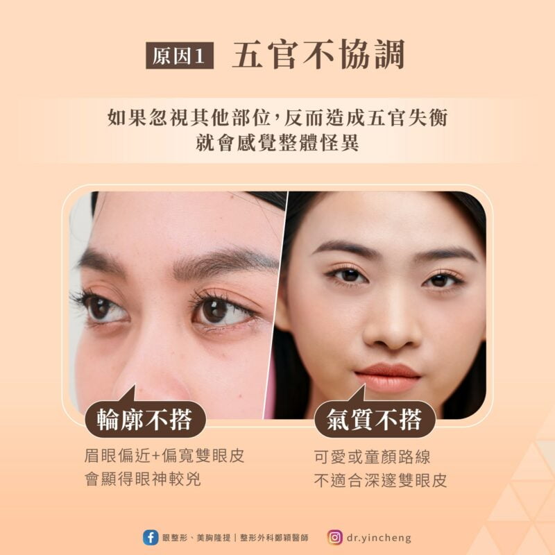 雙眼皮手術效果 五官不協調