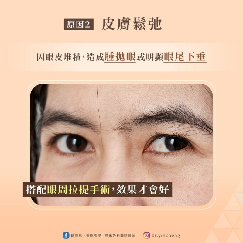 雙眼皮手術效果 皮膚鬆弛